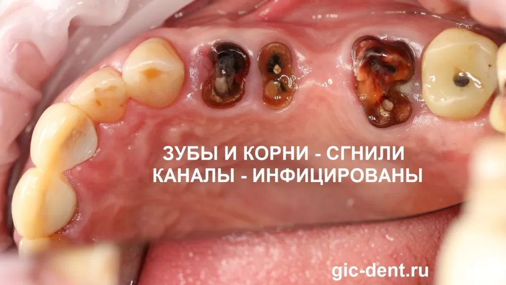 В корне зуба есть канал, если этот канал инфицирован, то проблема будет развиваться в негативном прогнозе. Воспаление, нагноение, периостит, остеомиелит